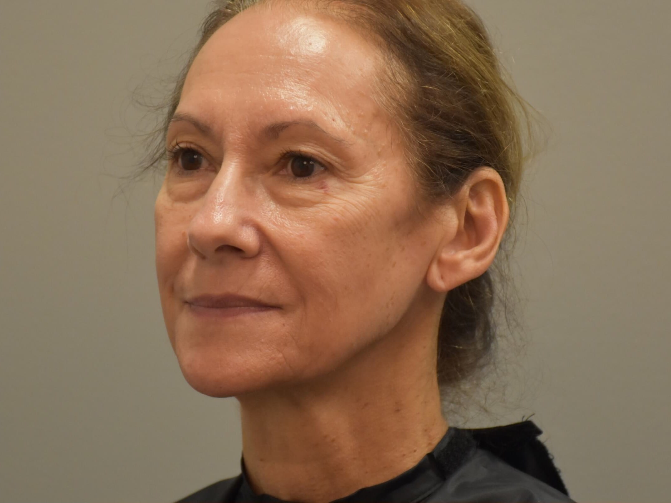 IPL Angled View After