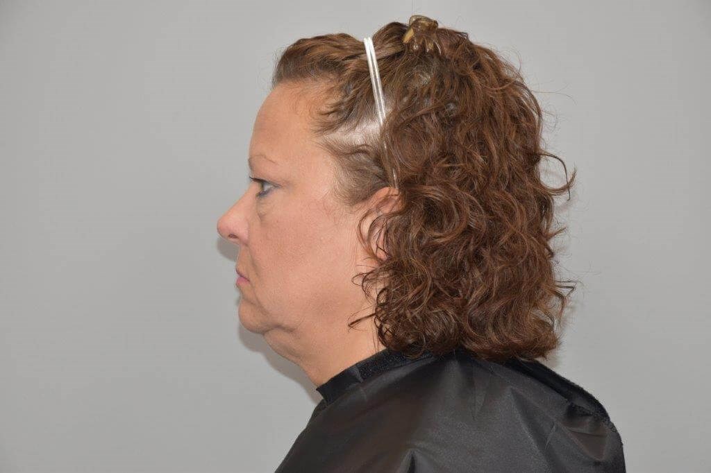 Facelift Left Side View Before