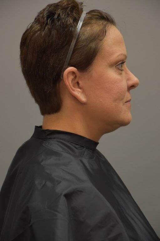 Facelift Right Side View After