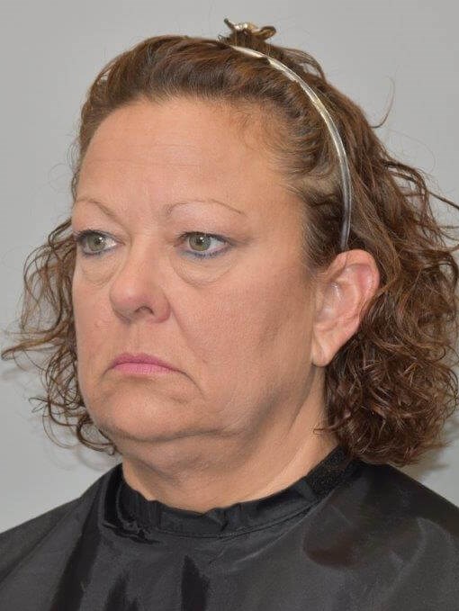 Facelift Left Angled View Before