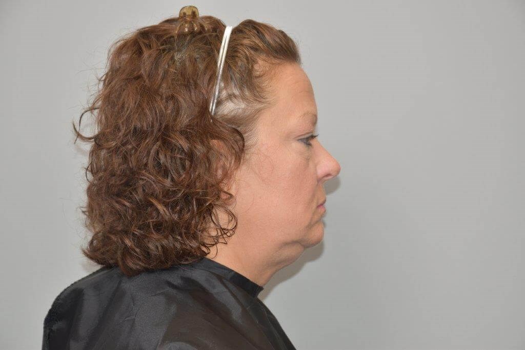 Facelift Right Side View Before