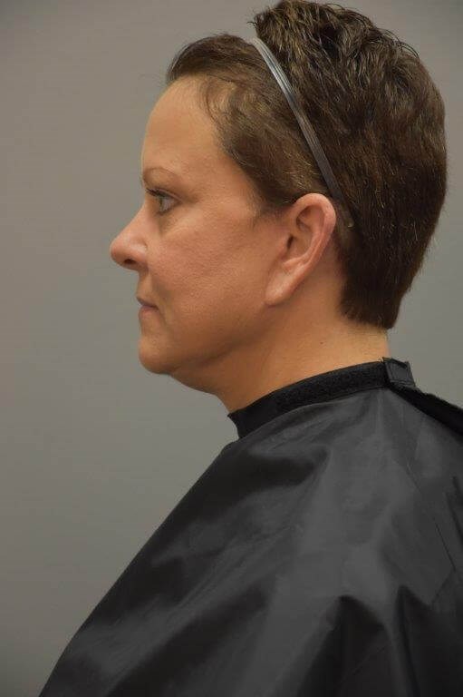 Facelift Left Side View After