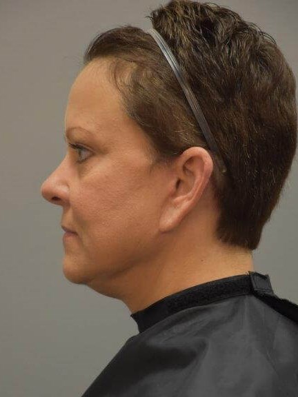 Facelift Left Side View After