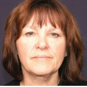 Facelift Surgery Before