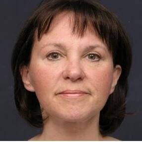 Facelift Surgery After