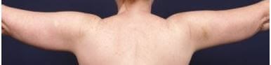 Armlift Surgery in Atlanta, GA After