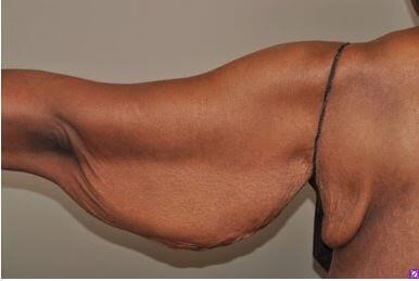 Armlift Surgery in Atlanta, GA Before