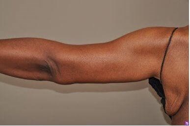 Armlift Surgery in Atlanta, GA After