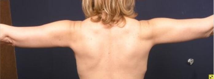 Armlift Surgery in Atlanta, GA After