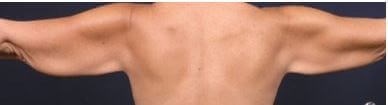 Armlift Surgery in Atlanta, GA Before