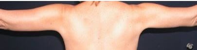 Armlift Surgery in Atlanta, GA After