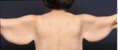 Armlift Surgery in Atlanta, GA Before