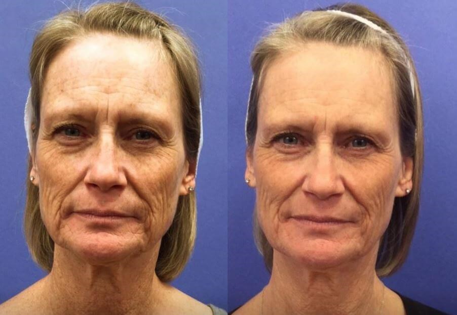 HALO LASER SKIN REJUVENATION