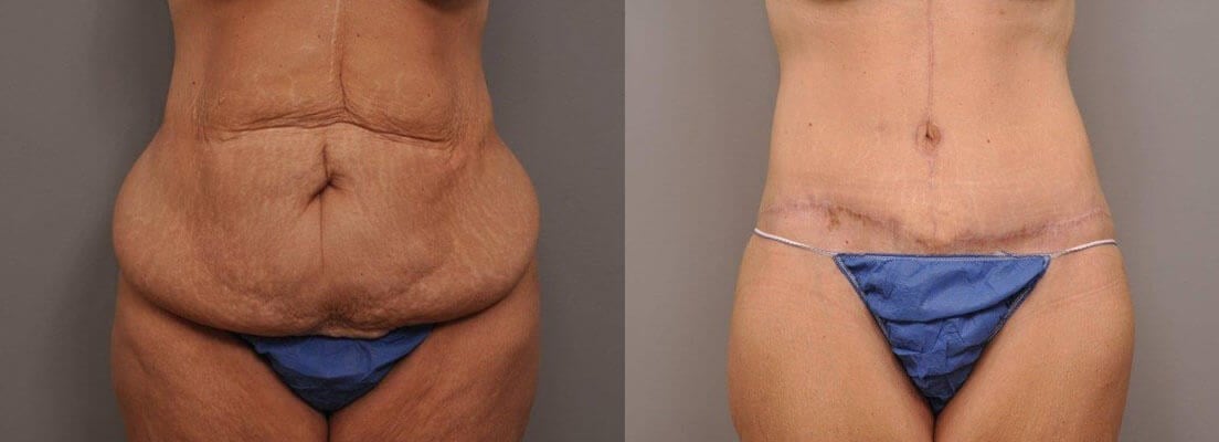 Apronectomy To Remove Loose Tummy Skin