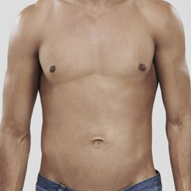 Gynecomastia  Image