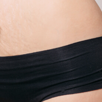 Laser Stretch Mark Reduction